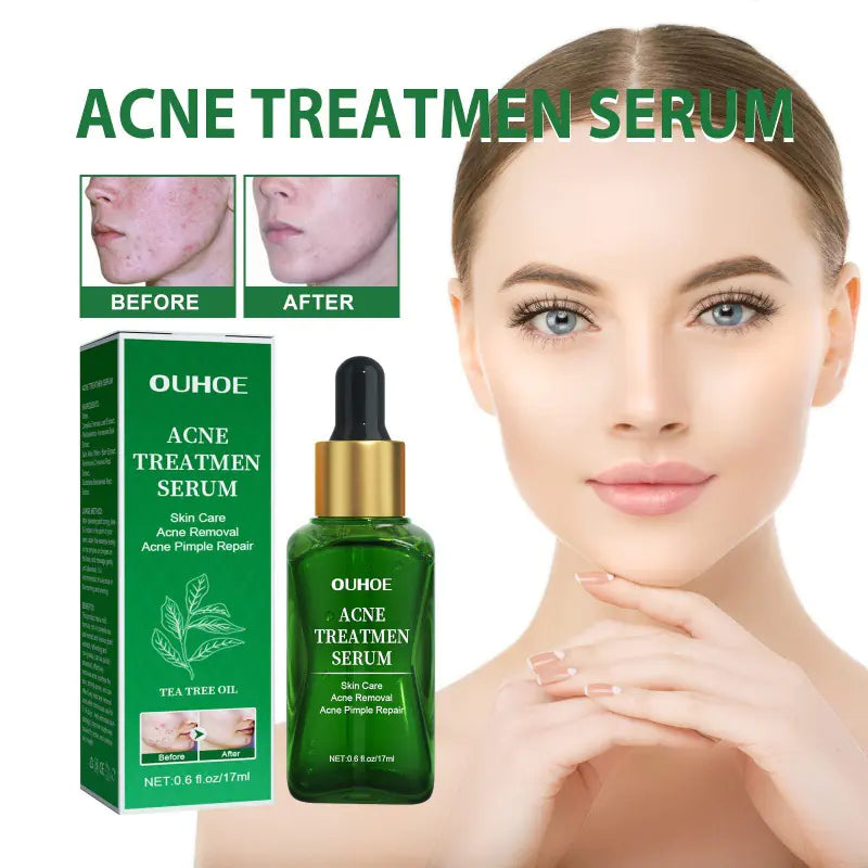 OUHOE Anti-Acne Ansiktsserum för oljekontroll och porer