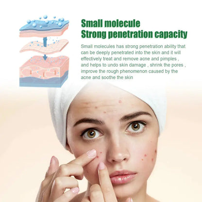 OUHOE Anti-Acne Ansiktsserum för oljekontroll och porer