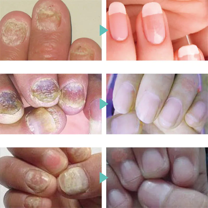 Nail Serum for Foot Care and Fungus Removal Gel 