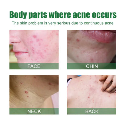OUHOE Anti-Acne Ansiktsserum för oljekontroll och porer