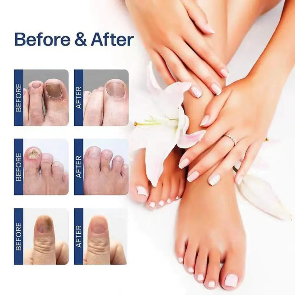 Nail Fungus Treatment Serum for Hand and Foot Care